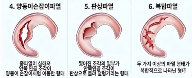 반월상연골판의 파열형태 중 양동이손잡이파열, 판상파열,복합파열의 이미지입니다. 
