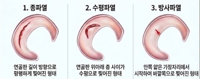 반월상연골판의 파열형태 중 종파열, 수평파열, 방사파열의 이미지입니다. 